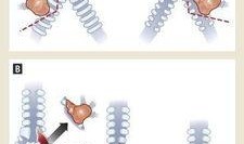 支气管可以吃瓜,吃瓜也能助力健康呼吸