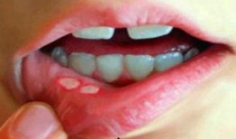 吃梨瓜吃的口腔溃疡,揭秘饮食与健康平衡之道