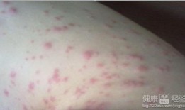 吃瓜过敏浑身红疙瘩,吃瓜引发的全身红疙瘩之谜